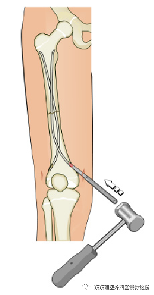 取髓内针有哪些器械儿童四肢不小心骨折了！怎么办？ 骨科微创帮您解决困难——儿童长骨骨折的弹性髓内针技术_https://www.jmylbn.com_新闻资讯_第13张