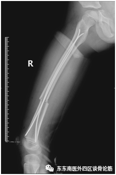 取髓内针有哪些器械儿童四肢不小心骨折了！怎么办？ 骨科微创帮您解决困难——儿童长骨骨折的弹性髓内针技术_https://www.jmylbn.com_新闻资讯_第11张