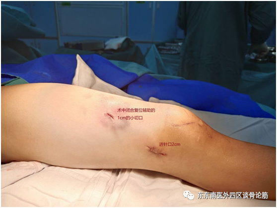 取髓内针有哪些器械儿童四肢不小心骨折了！怎么办？ 骨科微创帮您解决困难——儿童长骨骨折的弹性髓内针技术_https://www.jmylbn.com_新闻资讯_第7张