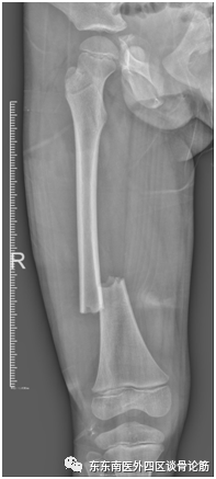 取髓内针有哪些器械儿童四肢不小心骨折了！怎么办？ 骨科微创帮您解决困难——儿童长骨骨折的弹性髓内针技术_https://www.jmylbn.com_新闻资讯_第3张