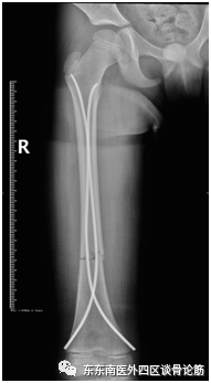 取髓内针有哪些器械儿童四肢不小心骨折了！怎么办？ 骨科微创帮您解决困难——儿童长骨骨折的弹性髓内针技术_https://www.jmylbn.com_新闻资讯_第10张