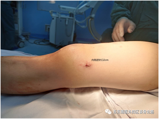 取髓内针有哪些器械儿童四肢不小心骨折了！怎么办？ 骨科微创帮您解决困难——儿童长骨骨折的弹性髓内针技术_https://www.jmylbn.com_新闻资讯_第8张