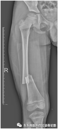 取髓内针有哪些器械儿童四肢不小心骨折了！怎么办？ 骨科微创帮您解决困难——儿童长骨骨折的弹性髓内针技术_https://www.jmylbn.com_新闻资讯_第2张