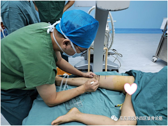 取髓内针有哪些器械儿童四肢不小心骨折了！怎么办？ 骨科微创帮您解决困难——儿童长骨骨折的弹性髓内针技术_https://www.jmylbn.com_新闻资讯_第4张