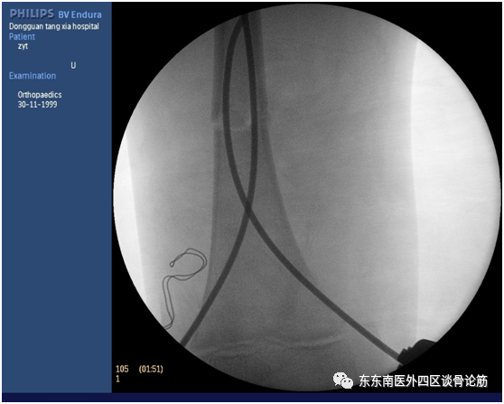 取髓内针有哪些器械儿童四肢不小心骨折了！怎么办？ 骨科微创帮您解决困难——儿童长骨骨折的弹性髓内针技术_https://www.jmylbn.com_新闻资讯_第6张