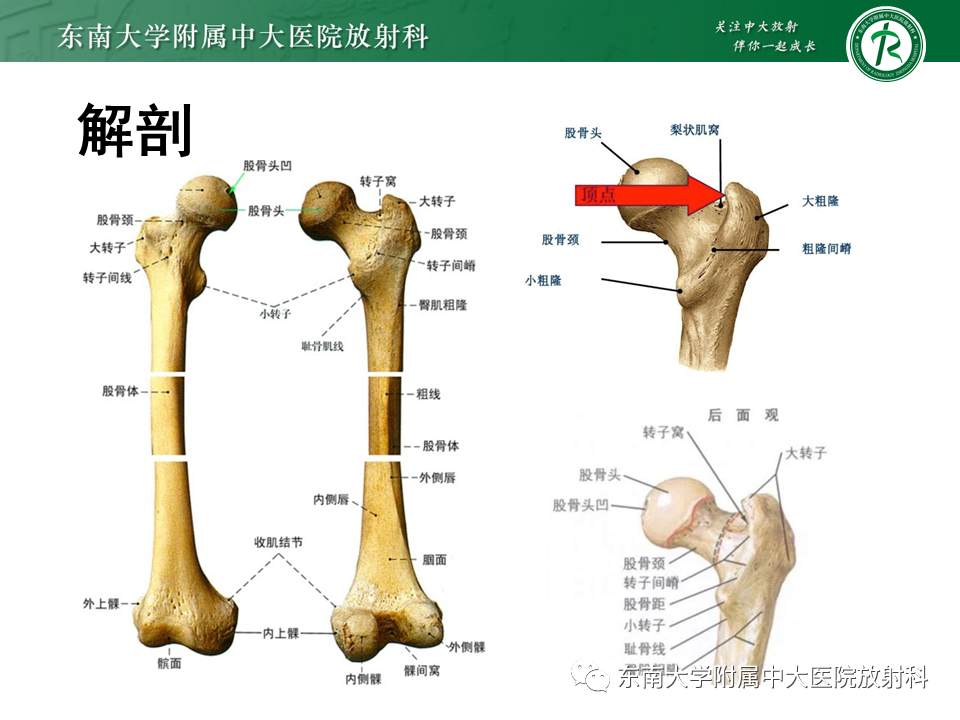 骨科基础丨股骨大转子疼痛综合征