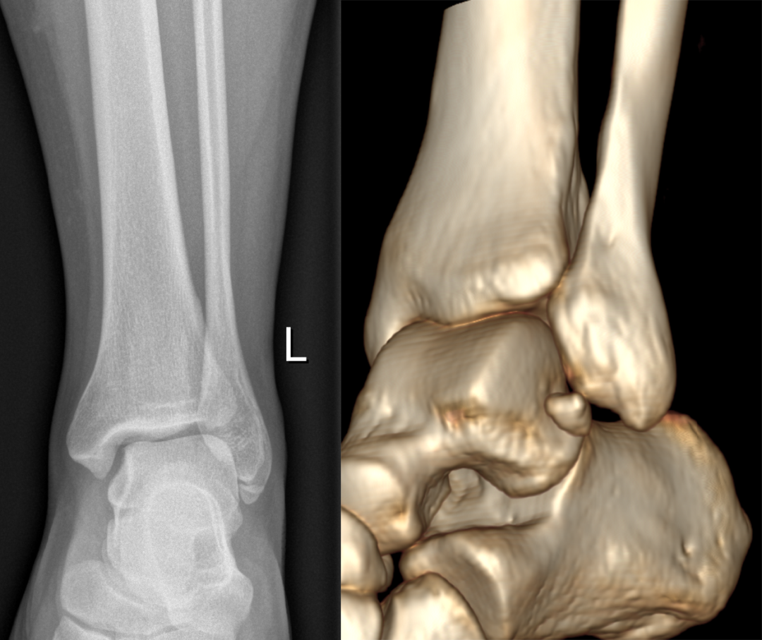 x 线及 ct 示腓骨下方示类圆形高密度影,边缘光整,腓骨远端完整,骨