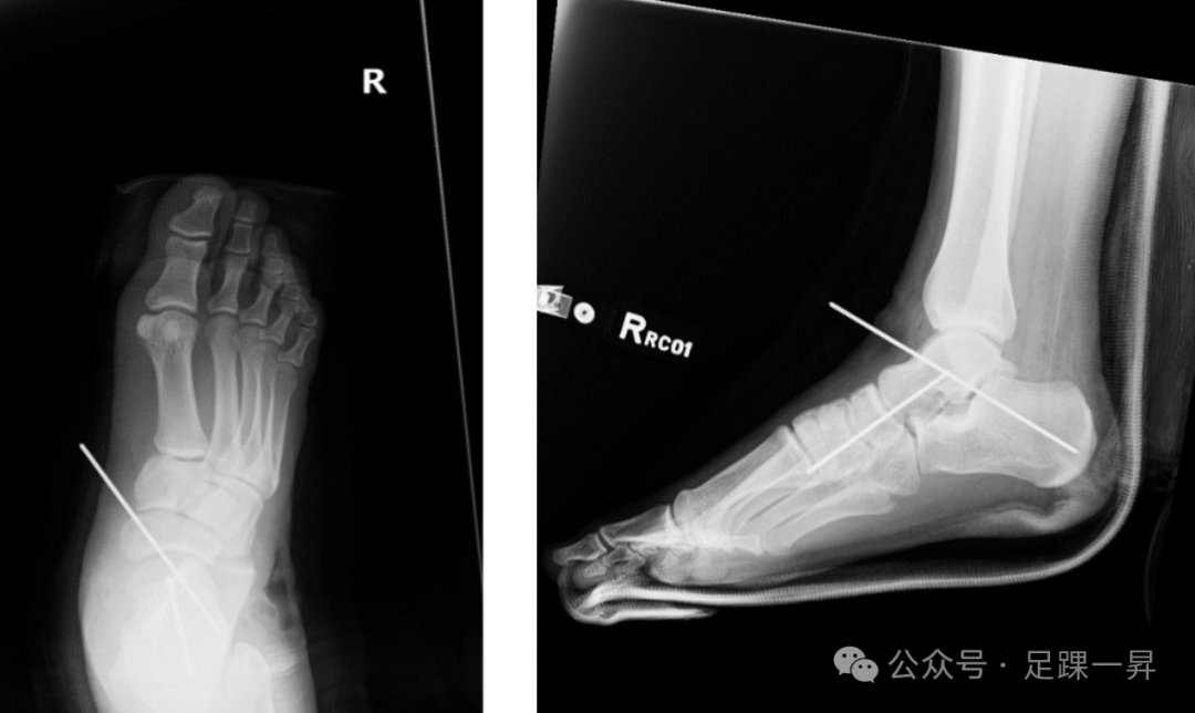 创伤性距下关节脱位(traumatic subtalar joint dislocation)