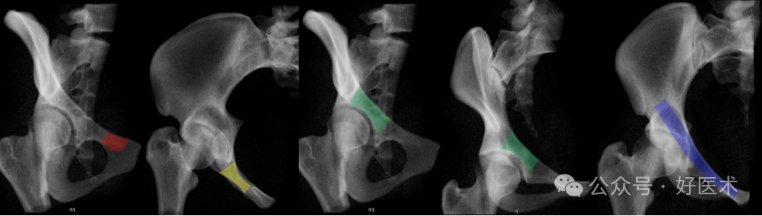 C臂透视怎么实现早读 ｜ 骨盆通道螺钉的透视和手术技术_https://www.jmylbn.com_新闻资讯_第13张