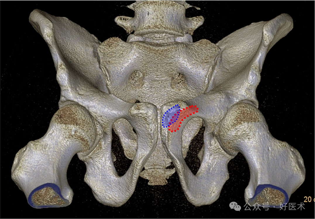 C臂透视怎么实现早读 ｜ 骨盆通道螺钉的透视和手术技术_https://www.jmylbn.com_新闻资讯_第12张