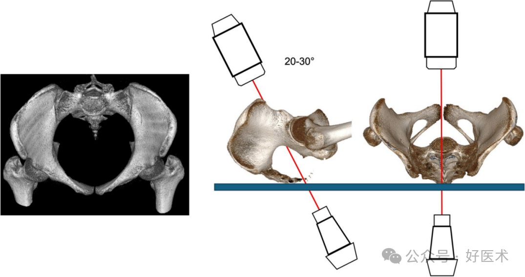 C臂透视怎么实现早读 ｜ 骨盆通道螺钉的透视和手术技术_https://www.jmylbn.com_新闻资讯_第4张