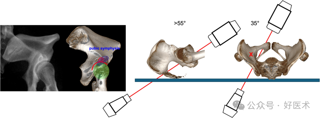 C臂透视怎么实现早读 ｜ 骨盆通道螺钉的透视和手术技术_https://www.jmylbn.com_新闻资讯_第15张