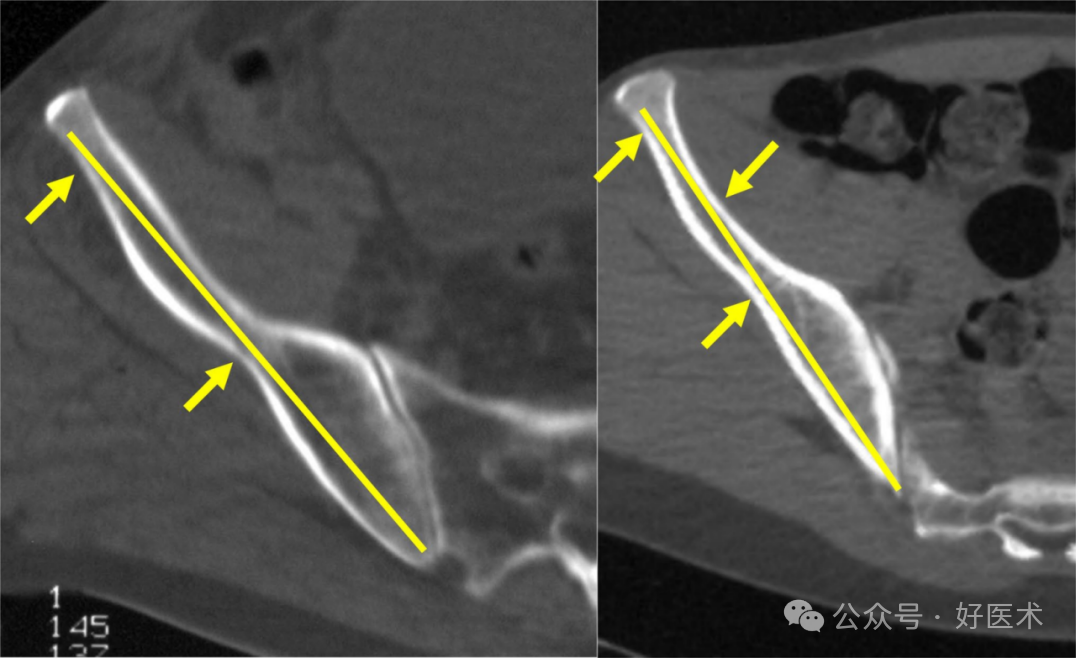 C臂透视怎么实现早读 ｜ 骨盆通道螺钉的透视和手术技术_https://www.jmylbn.com_新闻资讯_第18张