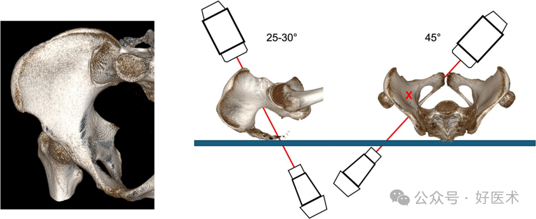 C臂透视怎么实现早读 ｜ 骨盆通道螺钉的透视和手术技术_https://www.jmylbn.com_新闻资讯_第9张