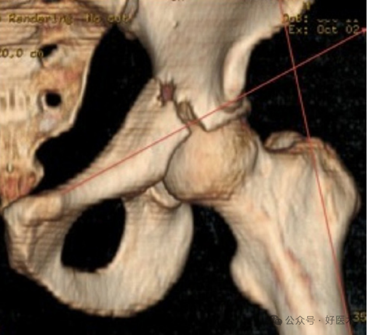 C臂透视怎么实现早读 ｜ 骨盆通道螺钉的透视和手术技术_https://www.jmylbn.com_新闻资讯_第14张
