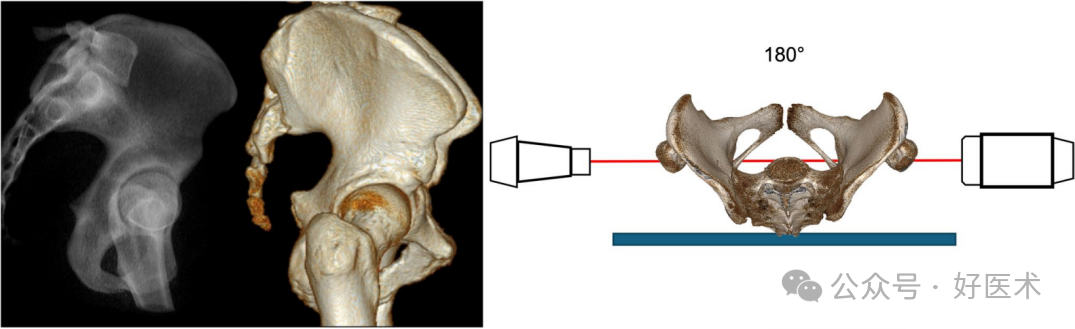 C臂透视怎么实现早读 ｜ 骨盆通道螺钉的透视和手术技术_https://www.jmylbn.com_新闻资讯_第10张