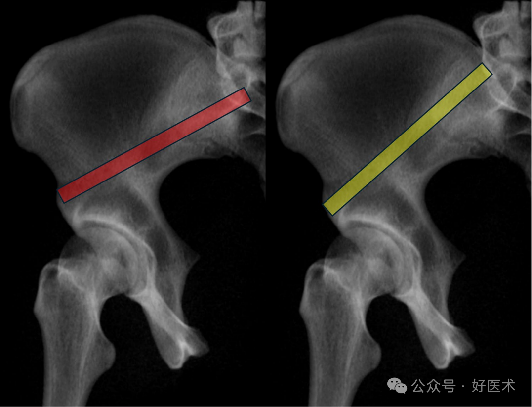 C臂透视怎么实现早读 ｜ 骨盆通道螺钉的透视和手术技术_https://www.jmylbn.com_新闻资讯_第19张