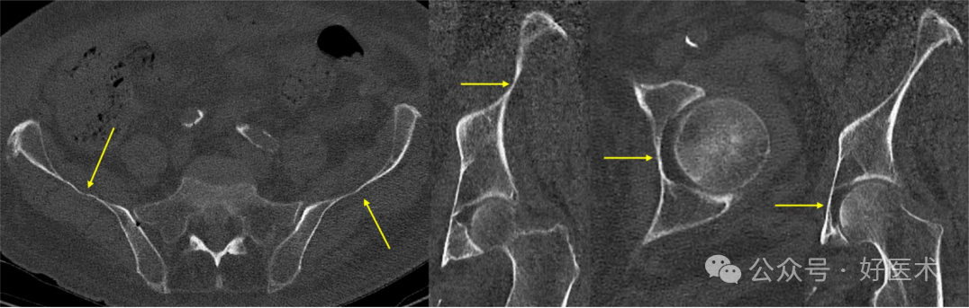 C臂透视怎么实现早读 ｜ 骨盆通道螺钉的透视和手术技术_https://www.jmylbn.com_新闻资讯_第2张