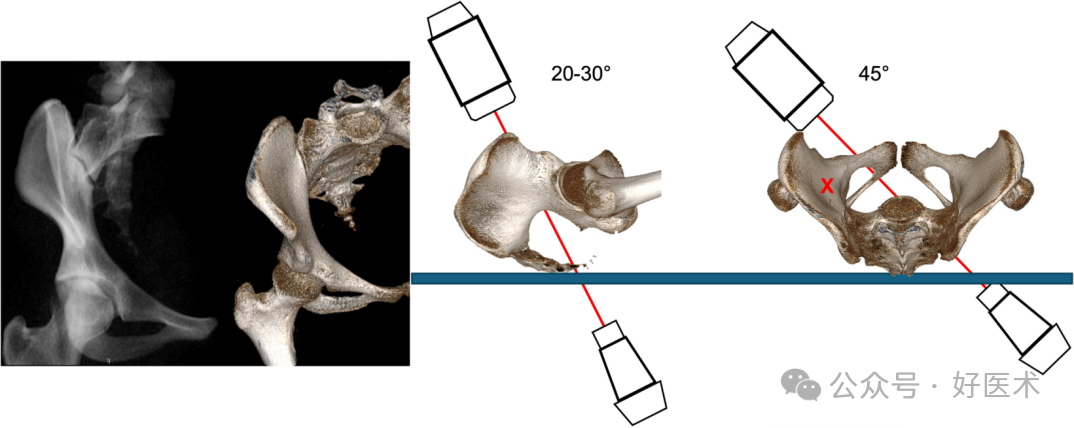 C臂透视怎么实现早读 ｜ 骨盆通道螺钉的透视和手术技术_https://www.jmylbn.com_新闻资讯_第7张