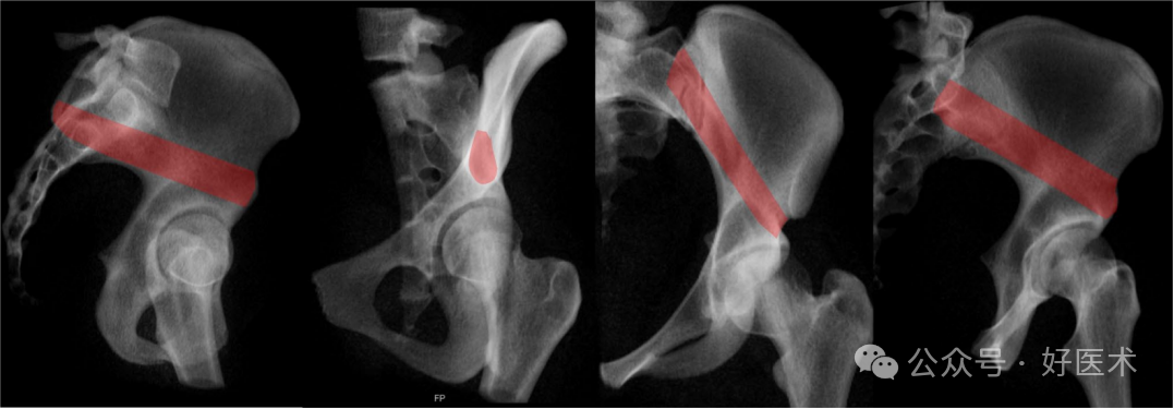C臂透视怎么实现早读 ｜ 骨盆通道螺钉的透视和手术技术_https://www.jmylbn.com_新闻资讯_第17张