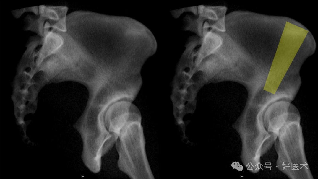 C臂透视怎么实现早读 ｜ 骨盆通道螺钉的透视和手术技术_https://www.jmylbn.com_新闻资讯_第20张