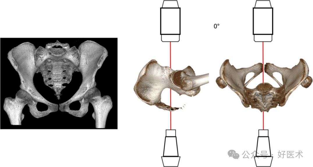 C臂透视怎么实现早读 ｜ 骨盆通道螺钉的透视和手术技术_https://www.jmylbn.com_新闻资讯_第3张
