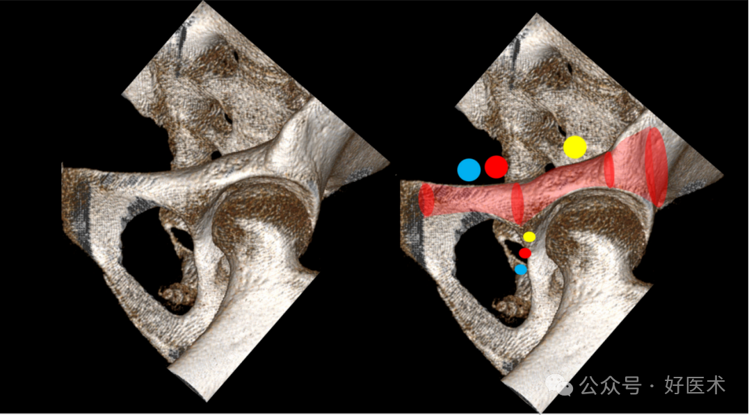 C臂透视怎么实现早读 ｜ 骨盆通道螺钉的透视和手术技术_https://www.jmylbn.com_新闻资讯_第11张