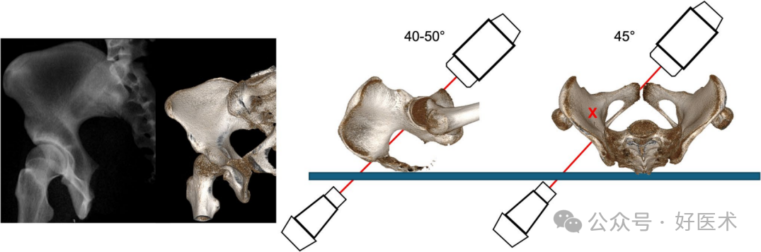C臂透视怎么实现早读 ｜ 骨盆通道螺钉的透视和手术技术_https://www.jmylbn.com_新闻资讯_第8张