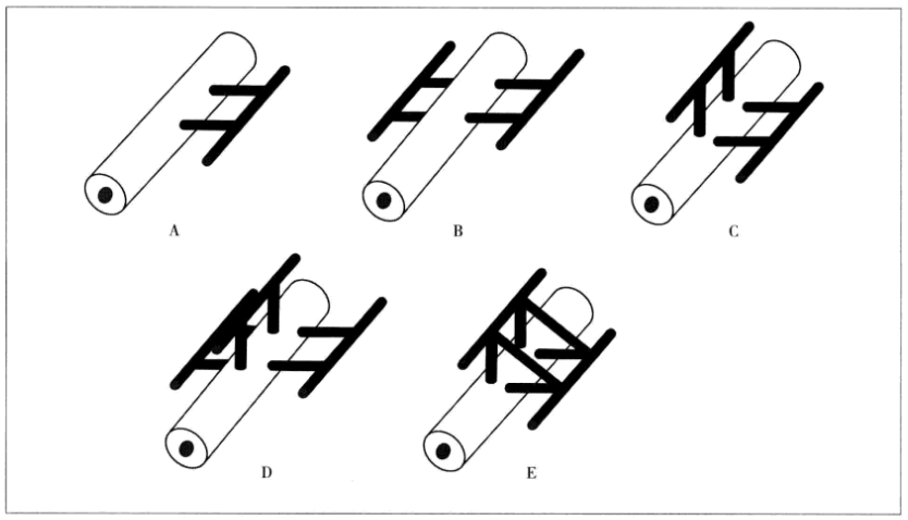 外固定支架是什么基层医师进阶攻略：全面认识骨折外固定_https://www.jmylbn.com_新闻资讯_第2张