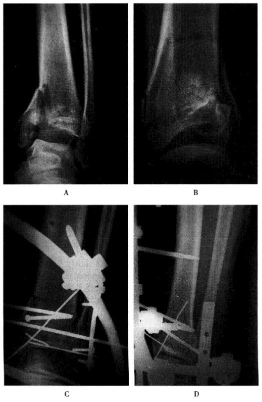 外固定支架是什么基层医师进阶攻略：全面认识骨折外固定_https://www.jmylbn.com_新闻资讯_第1张
