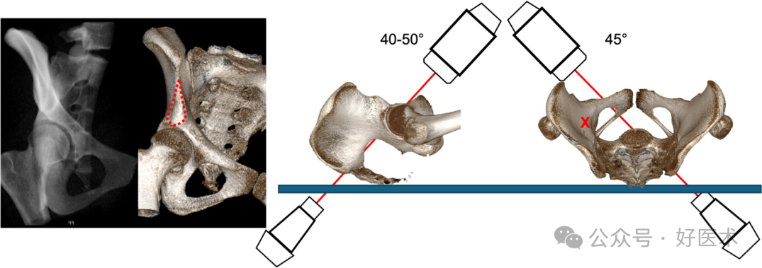 C臂透视怎么实现早读 ｜ 骨盆通道螺钉的透视和手术技术_https://www.jmylbn.com_新闻资讯_第6张