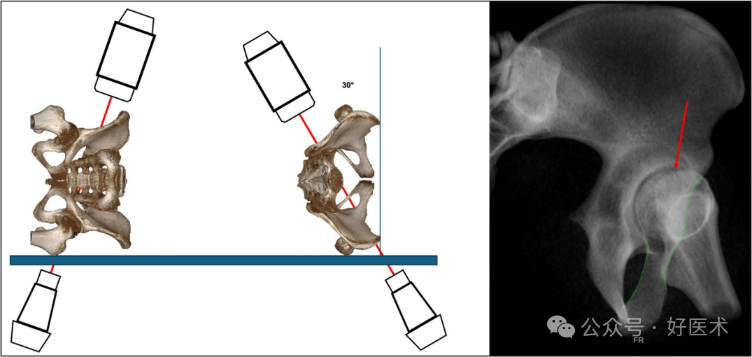 C臂透视怎么实现早读 ｜ 骨盆通道螺钉的透视和手术技术_https://www.jmylbn.com_新闻资讯_第16张