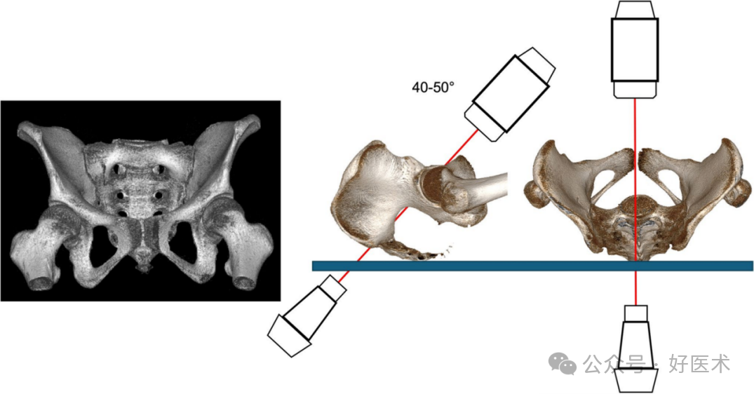 C臂透视怎么实现早读 ｜ 骨盆通道螺钉的透视和手术技术_https://www.jmylbn.com_新闻资讯_第5张