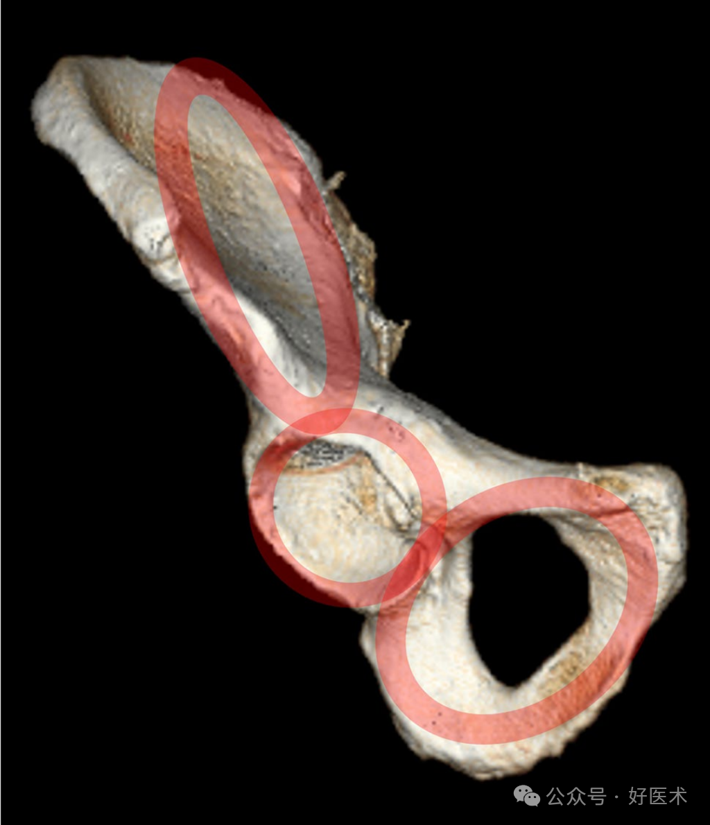 C臂透视怎么实现早读 ｜ 骨盆通道螺钉的透视和手术技术_https://www.jmylbn.com_新闻资讯_第1张