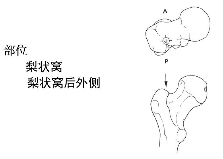 钉进针点:01屈膝30°01导针长轴与股骨干远段髓腔方向一致01经
