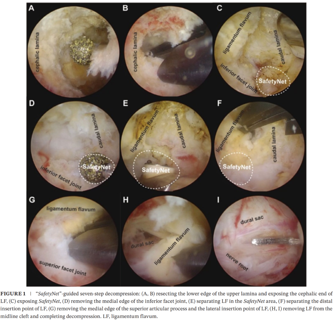 Unilateral Biportal Endoscopic Decompression for Degenerative Lumbar ...