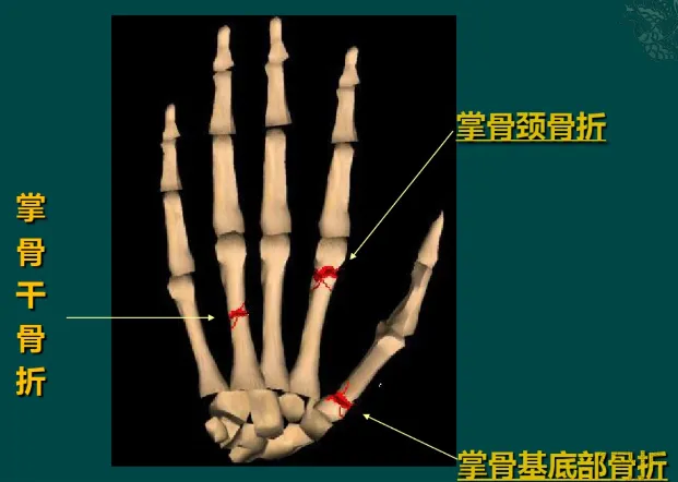 掌骨与指骨骨折的穿针治疗,这样做更完美! - 上海开为医药科技有限公司--创伤、肢体矫形技术解决方案的专业服务商